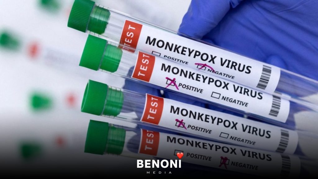 Mpox outbreak in Gauteng positive cases rise Benoni Media